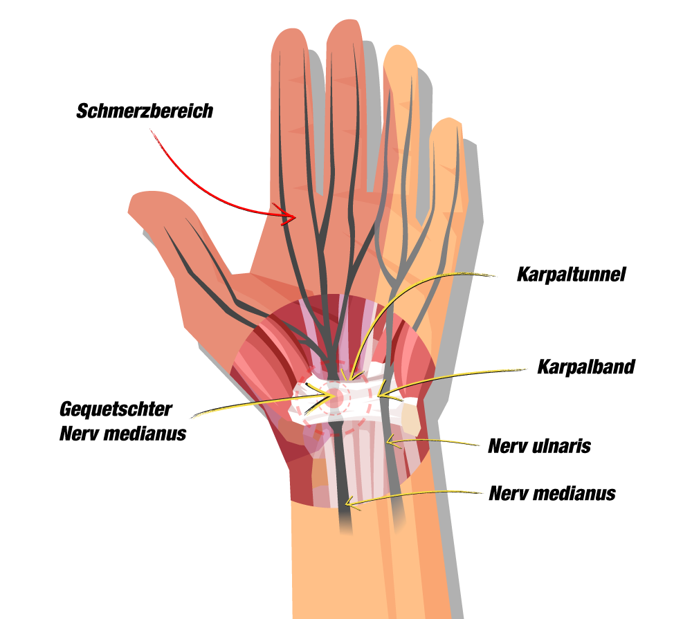 Karpaltunnelsyndrom Selbsthilfe Übungen OP verhindern